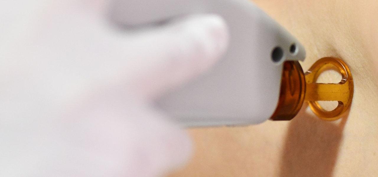 Depilacin laser - Foto